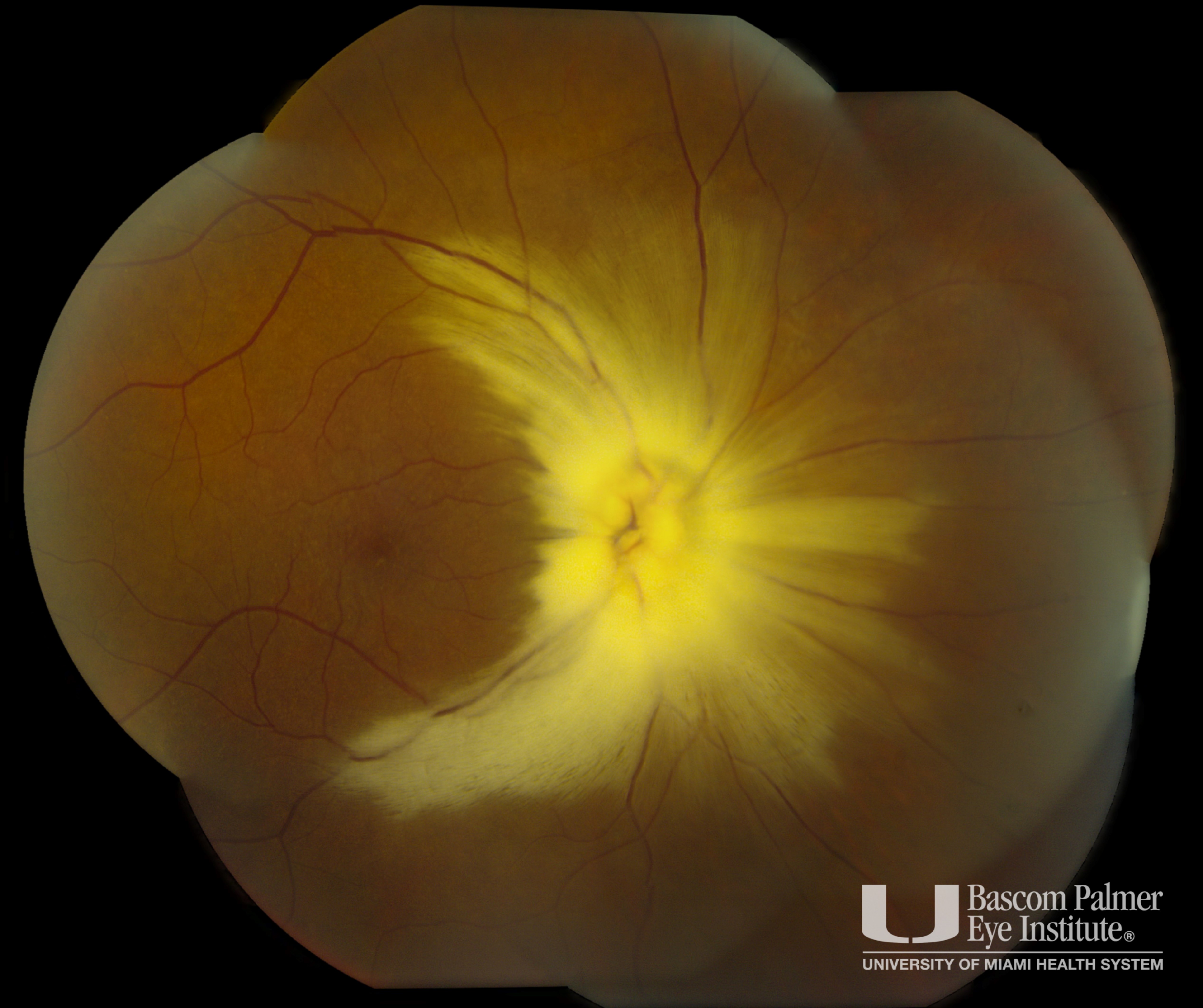 Course Myelinated Retinal Nerve Fiber Layer